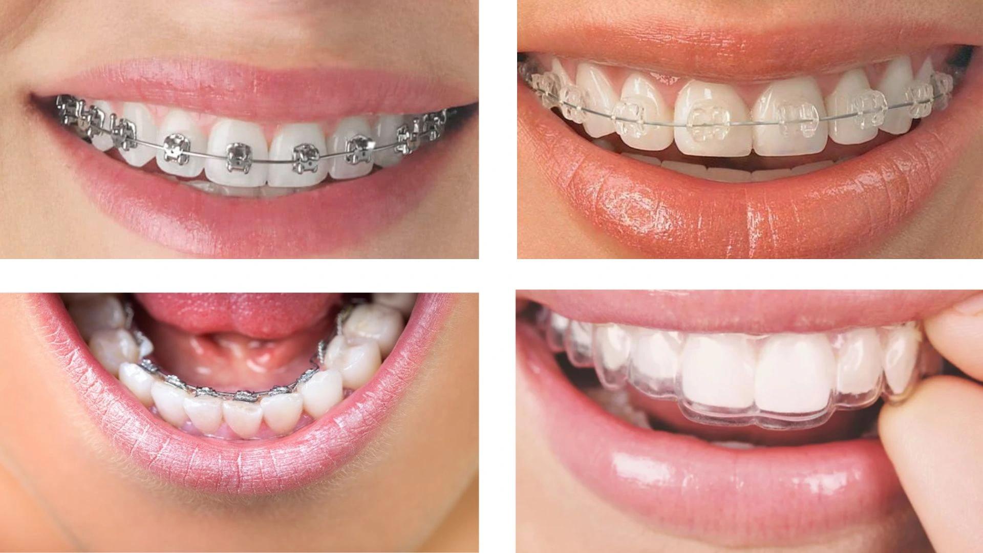 Braces and clear aligners