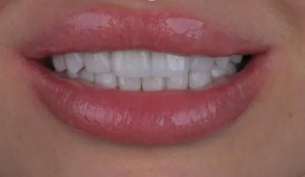 20% OFF E-max Ivoclar Veneers Package