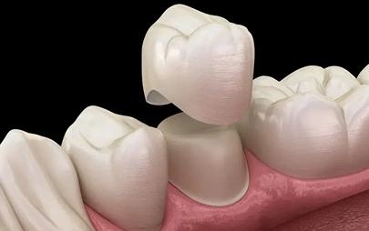 Dental crowns being put in a tooth