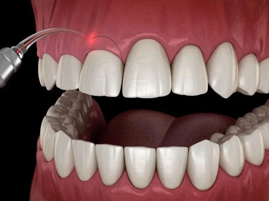 An image showing laser gum contouring for precise dental treatment.