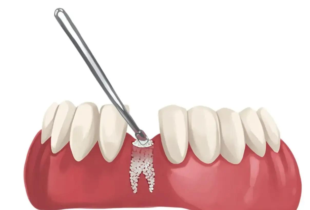 Bone deficiency requiring dental bone graft treatment