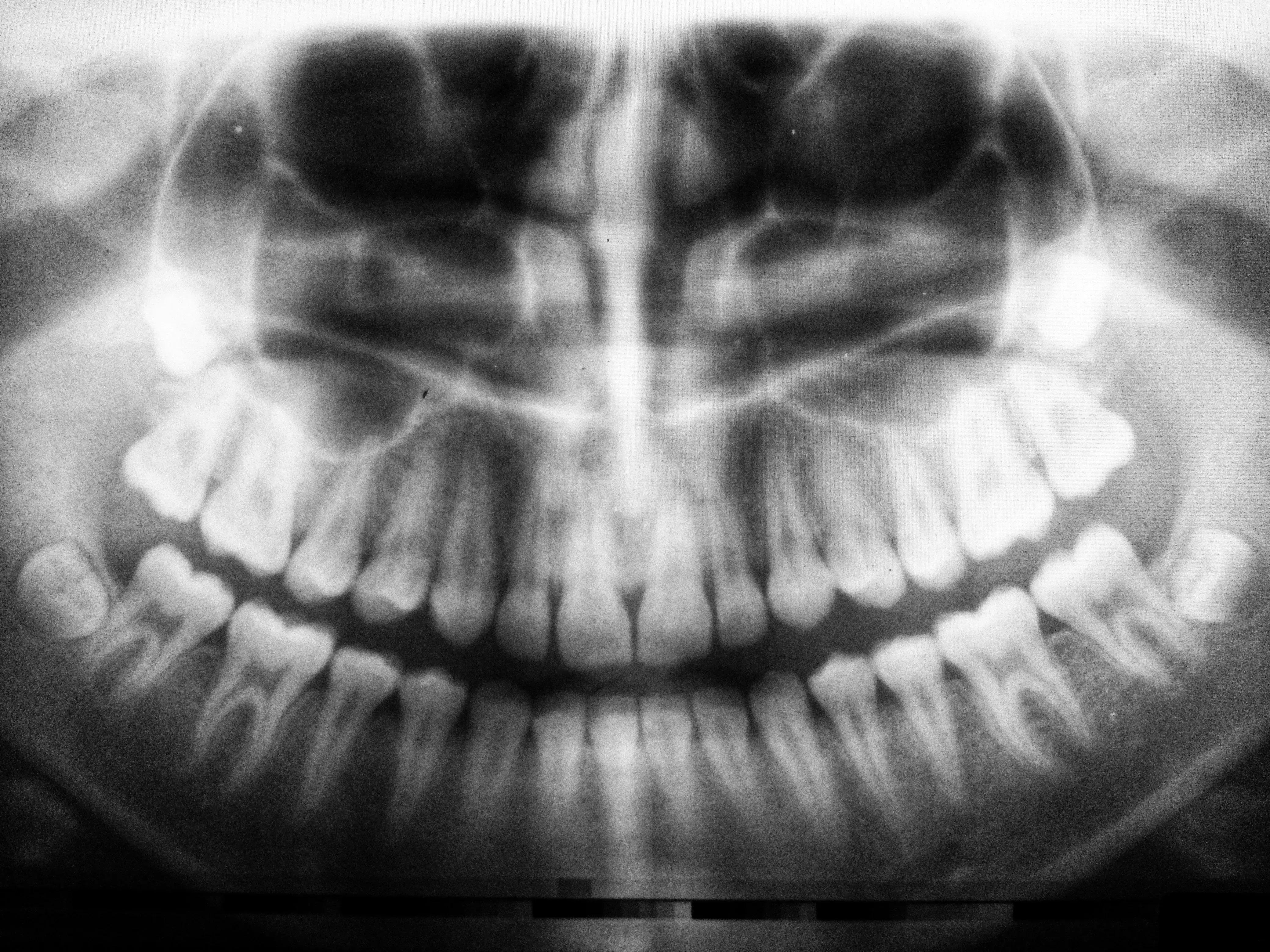 A full mouth dental x-rays