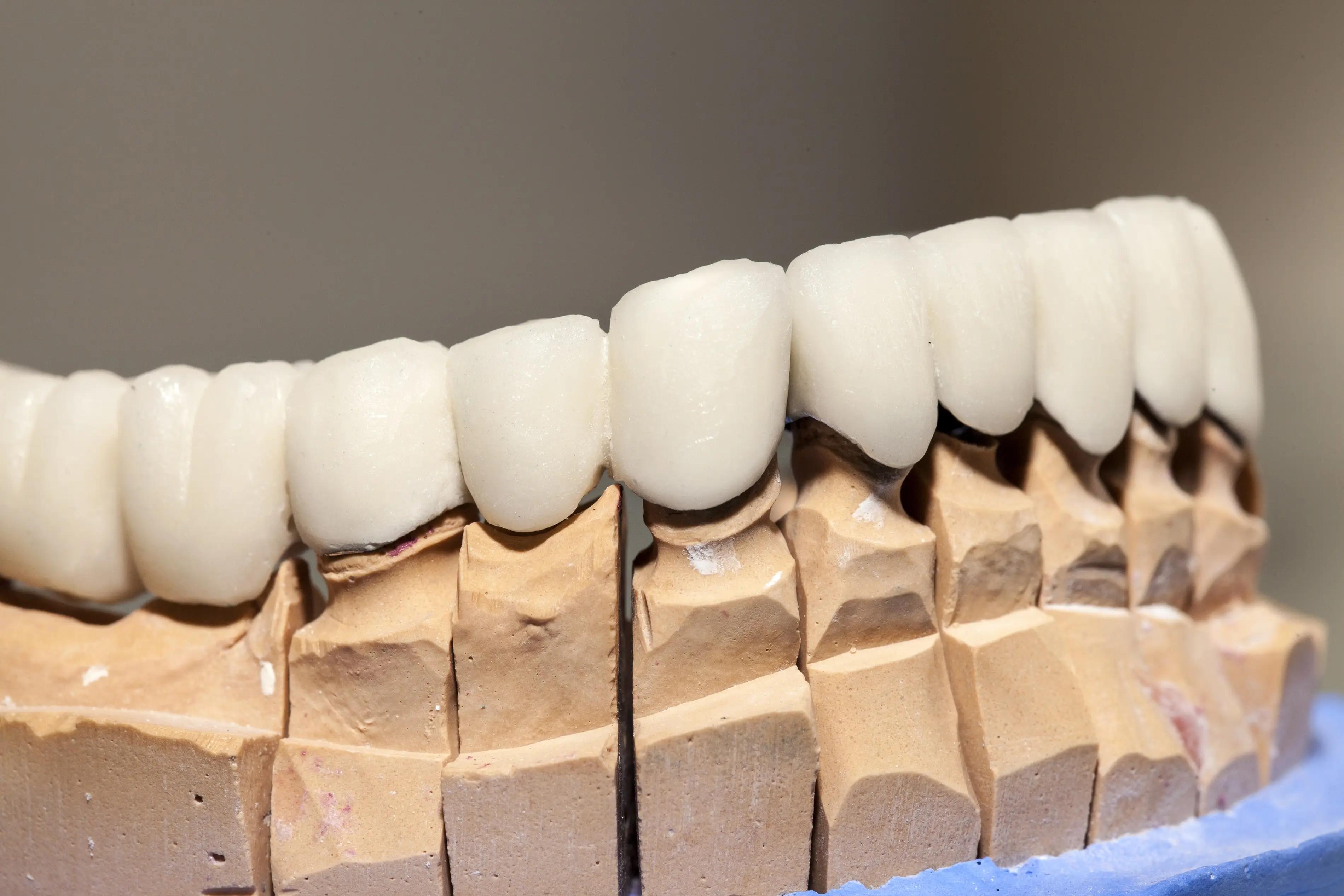 Image showing dental veneers-dental veneers and crowns comparison 