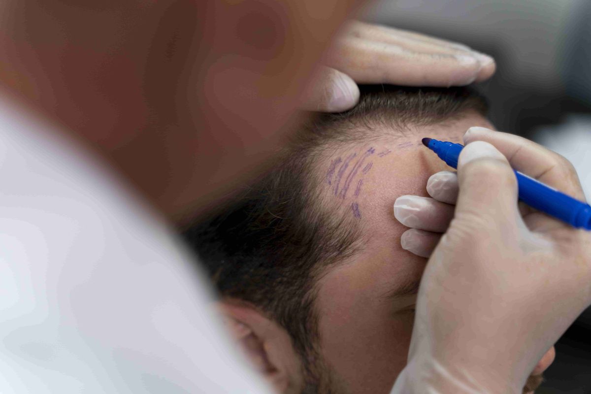 Exploring Scalp Micro Pigmentation: A Revolutionary Solution for Hair Loss
