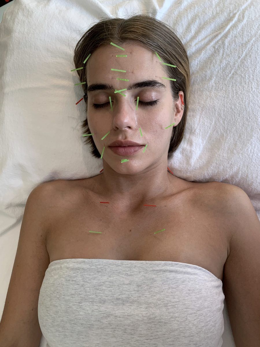 Facial acupuncture in progress