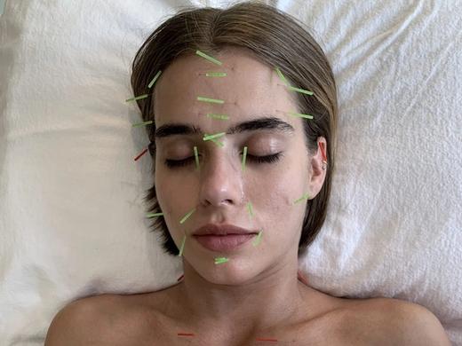 A woman lies on her back with her eyes closed and fine green needles set across her forehead, brow, cheeks, chin, neck and collarbones.