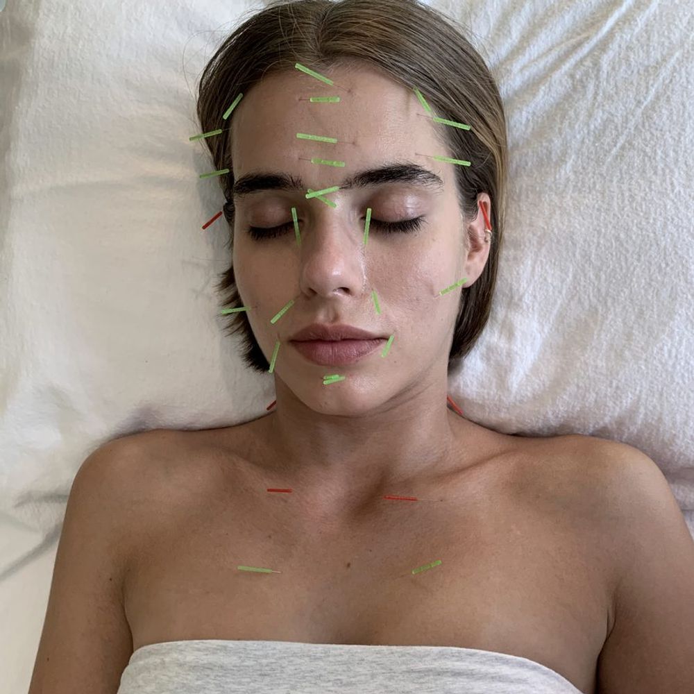 Facial acupuncture in progress