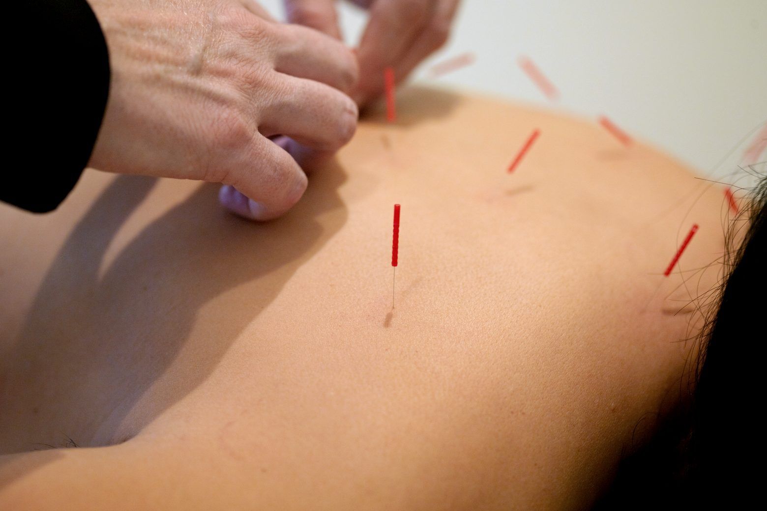 A practitioner's hands set a needle into a patient's upper back, several red-handled needles already standing in the surrounding skin.