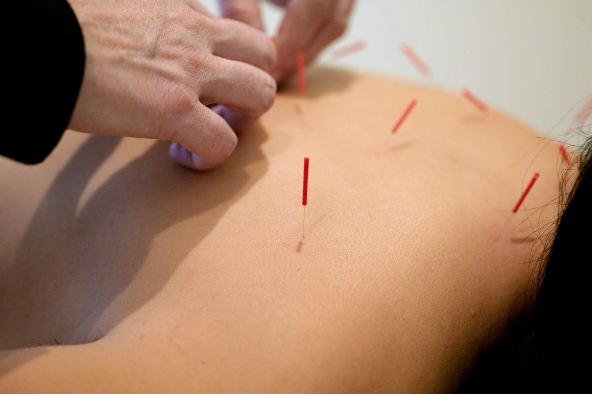 Needles in place during a treatment