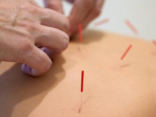 A practitioner's hands set a needle into a patient's upper back, several red-handled needles already standing in the surrounding skin.