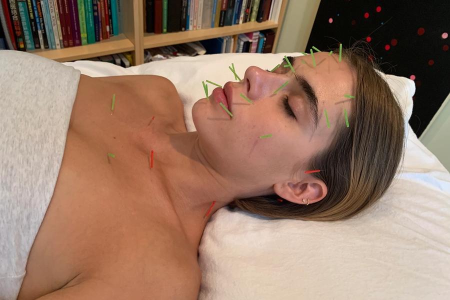 A woman rests her head on a pillow with her eyes closed while fine green and red needles stand in her brow, cheek, jaw, neck and upper chest.