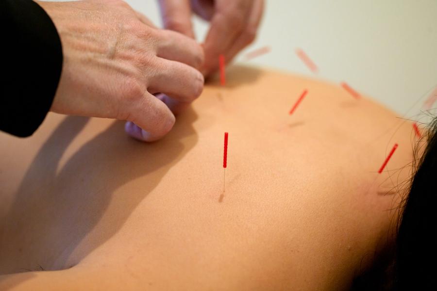 A practitioner's hands set a needle into a patient's upper back, several red-handled needles already standing in the surrounding skin.