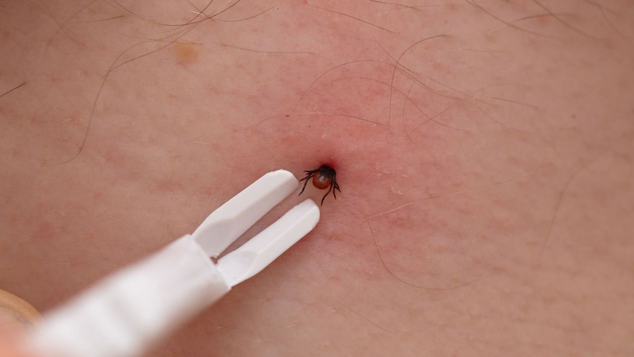 Removing deer tick with tweezers.