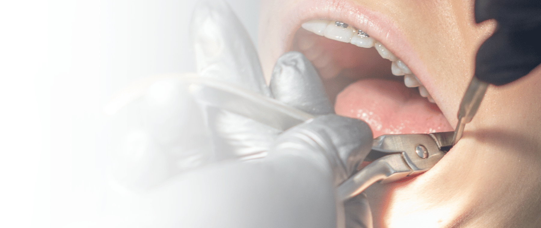 Dentist carrying out a tooth extraction in Lahore at DentoCorrect clinic