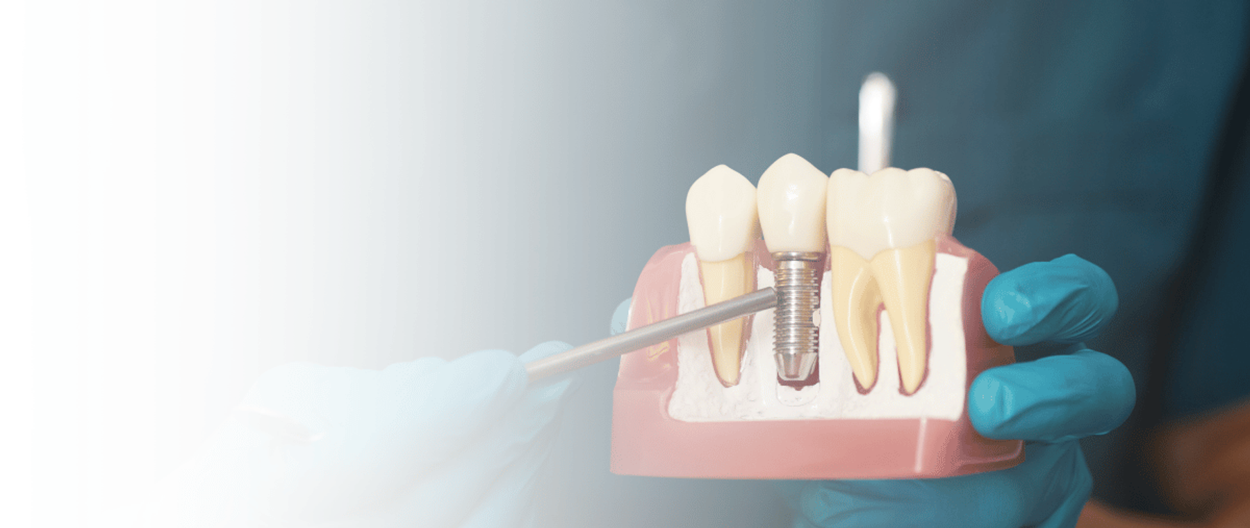 Dentist showing a dental implant model during a consultation for dental implants in Karachi