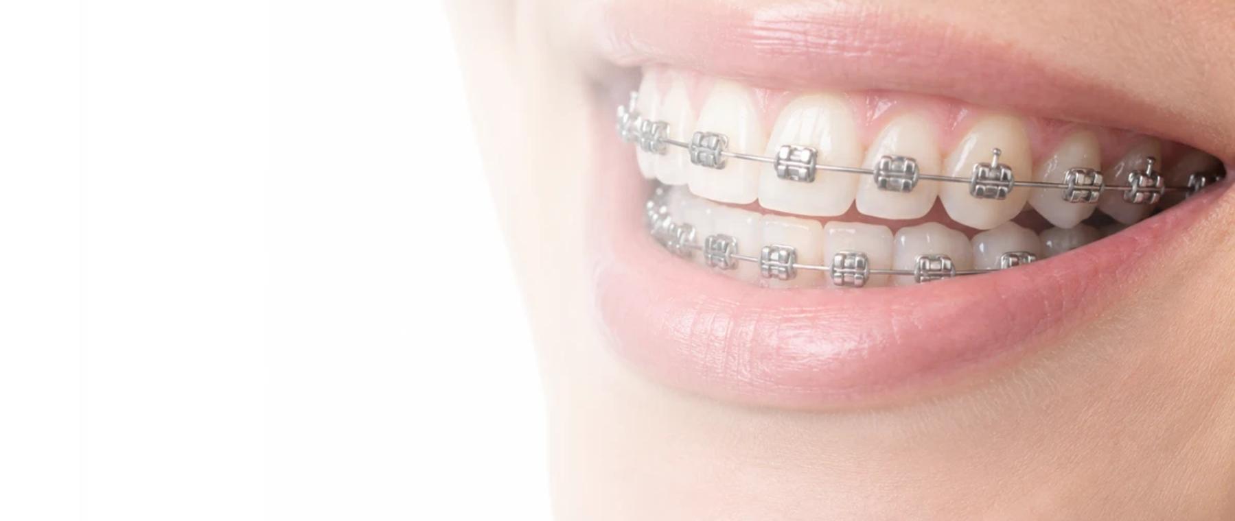 Close-up of metal teeth braces in Faisalabad at DentoCorrect People's Colony
