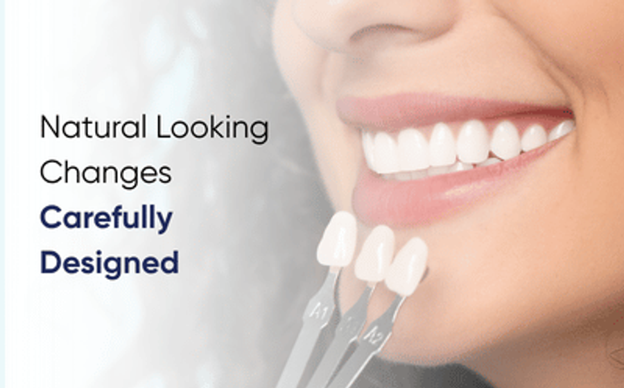 Dental veneers in Karachi matched against a patient smile using a shade guide