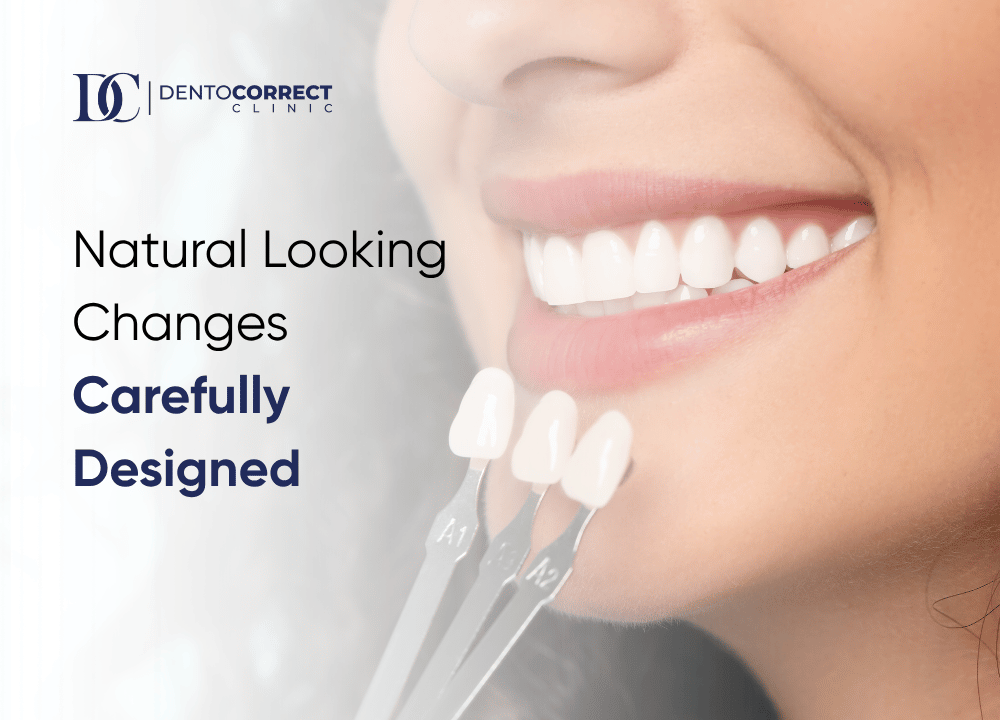 Porcelain veneer shade matching for dental veneers in Karachi