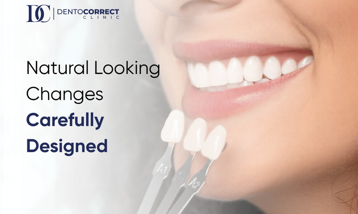 Porcelain veneer shade matching for dental veneers in Karachi