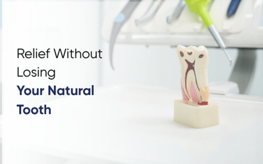 Tooth model showing the root canals during treatment in Multan at DentoCorrect