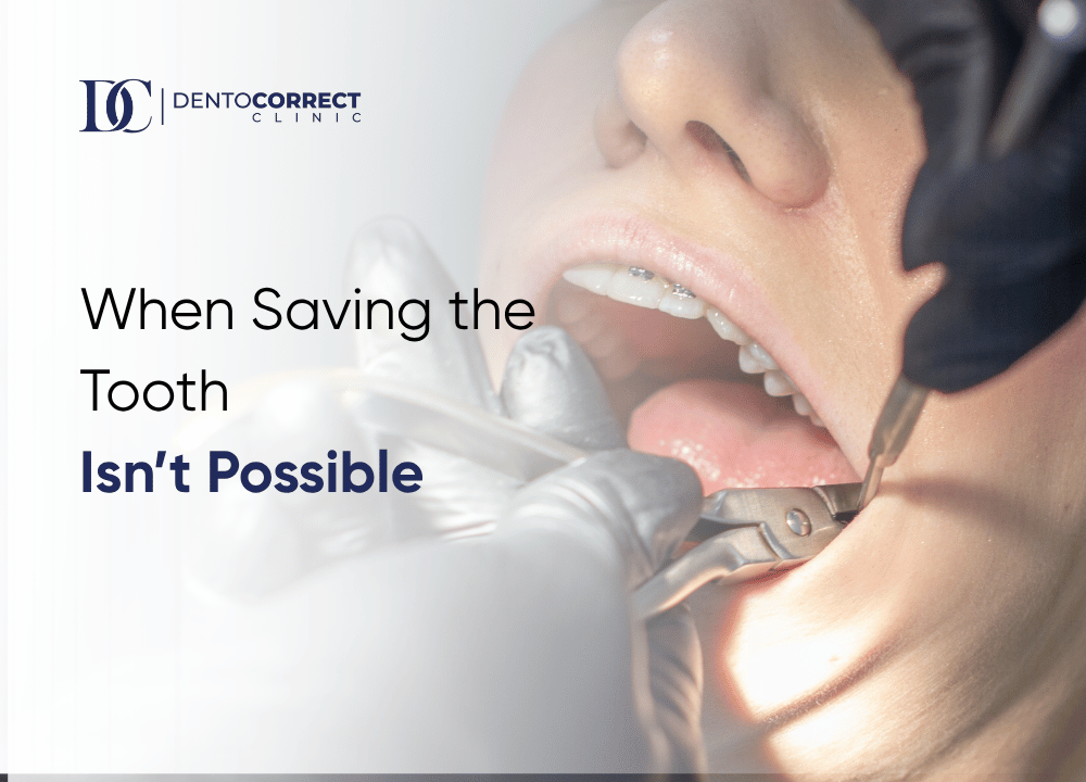 Tooth extraction in Lahore when saving the tooth is not possible