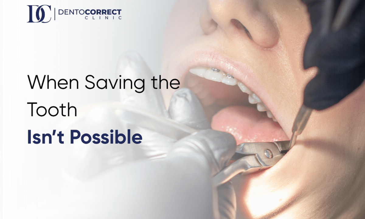 Tooth extraction in Lahore when saving the tooth is not possible