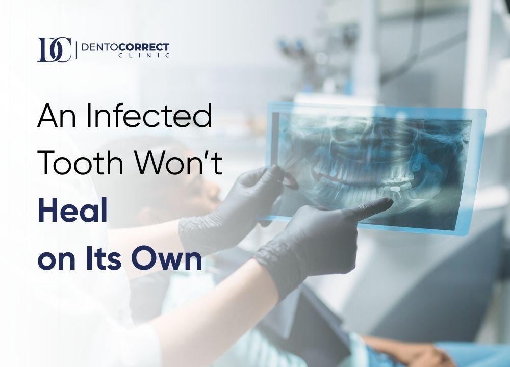 Root canal treatment in Rawalpindi for an infected tooth