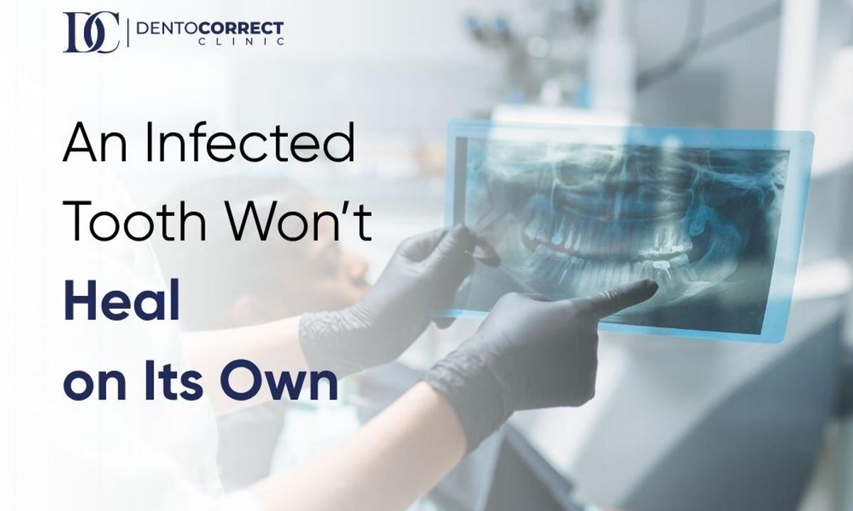 Root canal treatment in Rawalpindi for an infected tooth