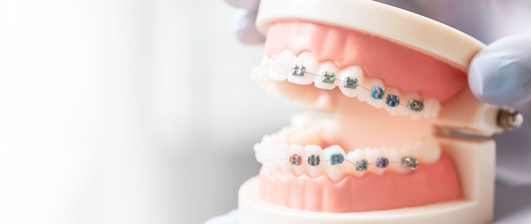 Model showing teeth braces for adult orthodontic treatment in Multan