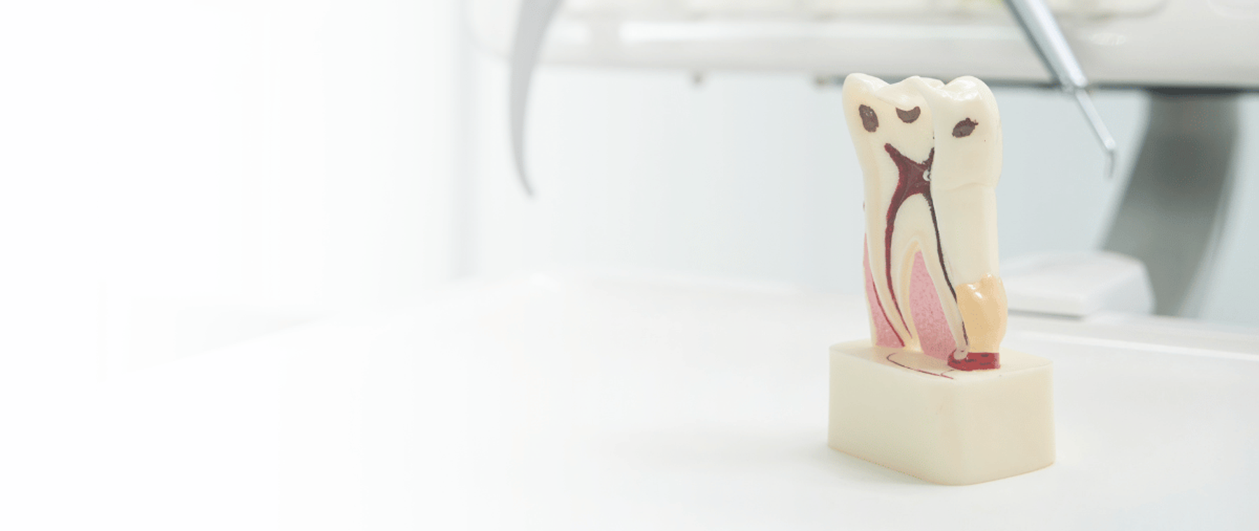 Tooth model showing the root canals during treatment in Multan at DentoCorrect