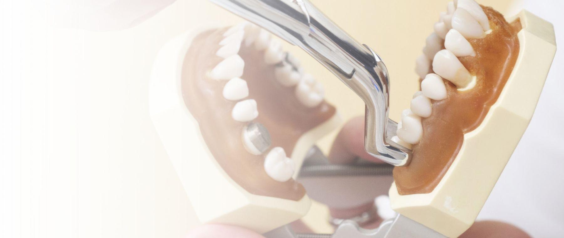 Tooth extraction in Multan shown on a dental model at DentoCorrect