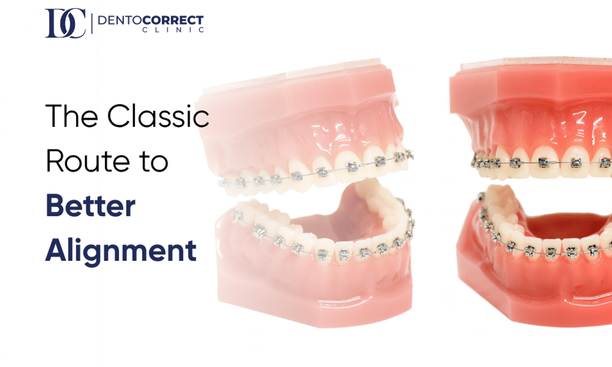 Metal braces on dental models for teeth braces treatment in Lahore