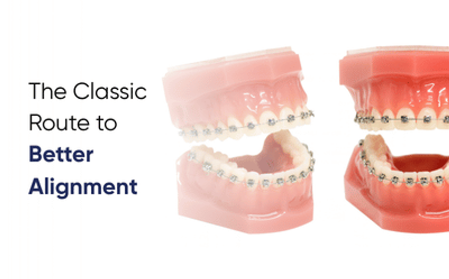 Teeth braces in Lahore shown on upper and lower dental models at DentoCorrect