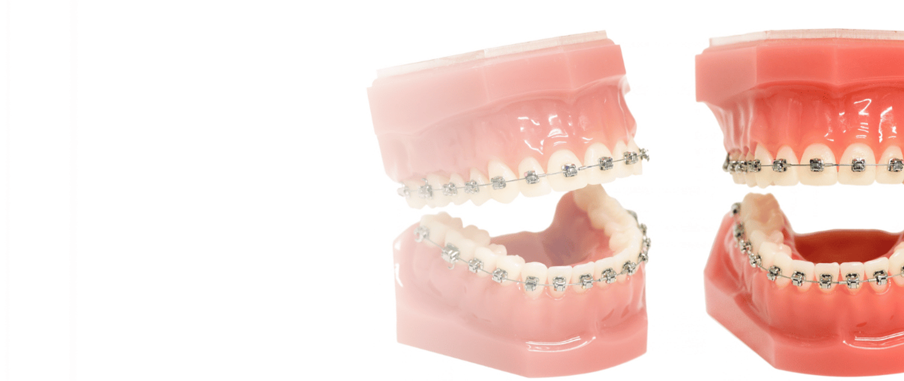 Teeth braces in Lahore shown on upper and lower dental models at DentoCorrect