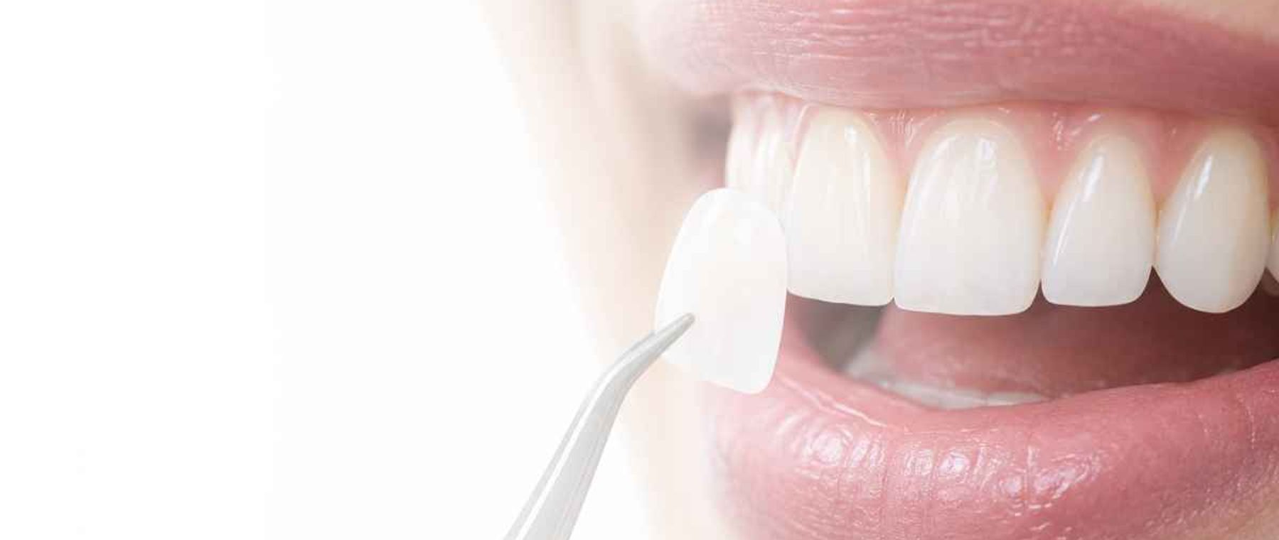Dentist placing a porcelain veneer for dental veneers in Multan at DentoCorrect
