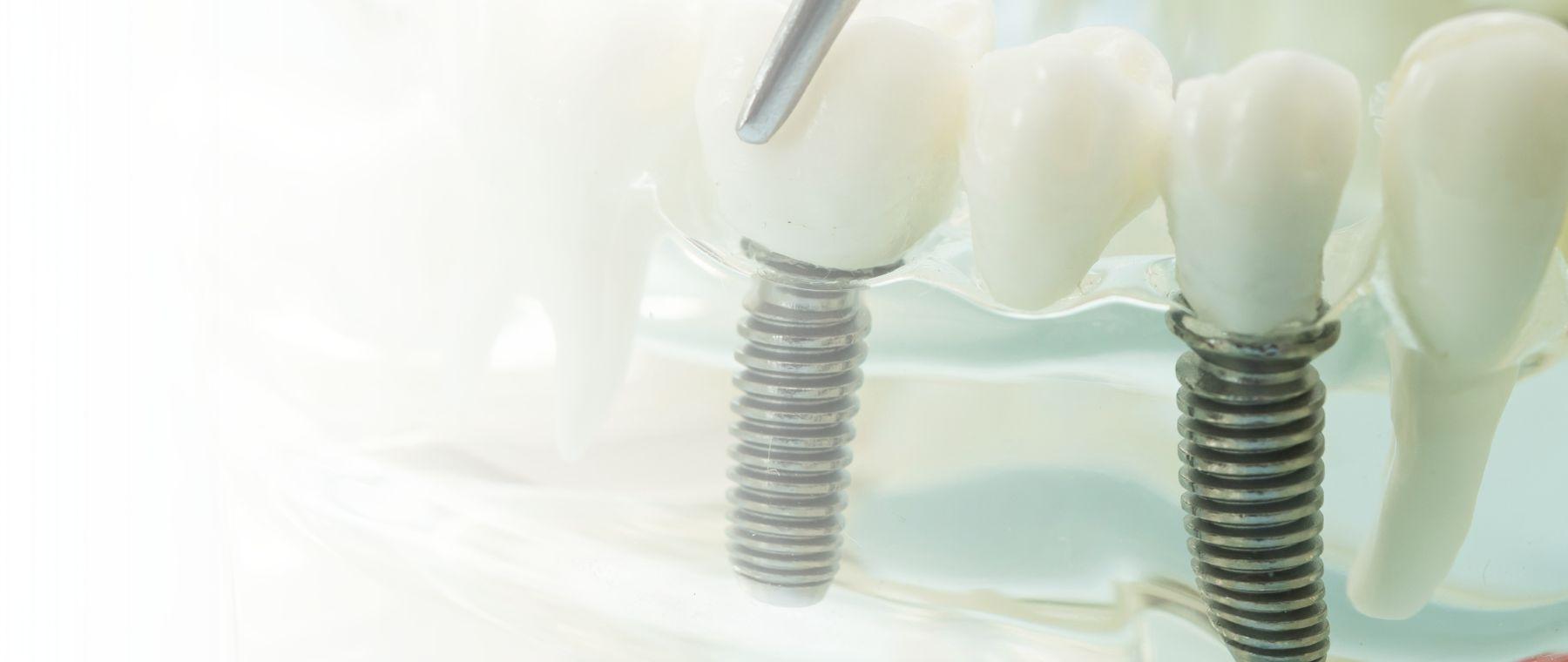 Dental implants in Islamabad shown on a jaw model at DentoCorrect