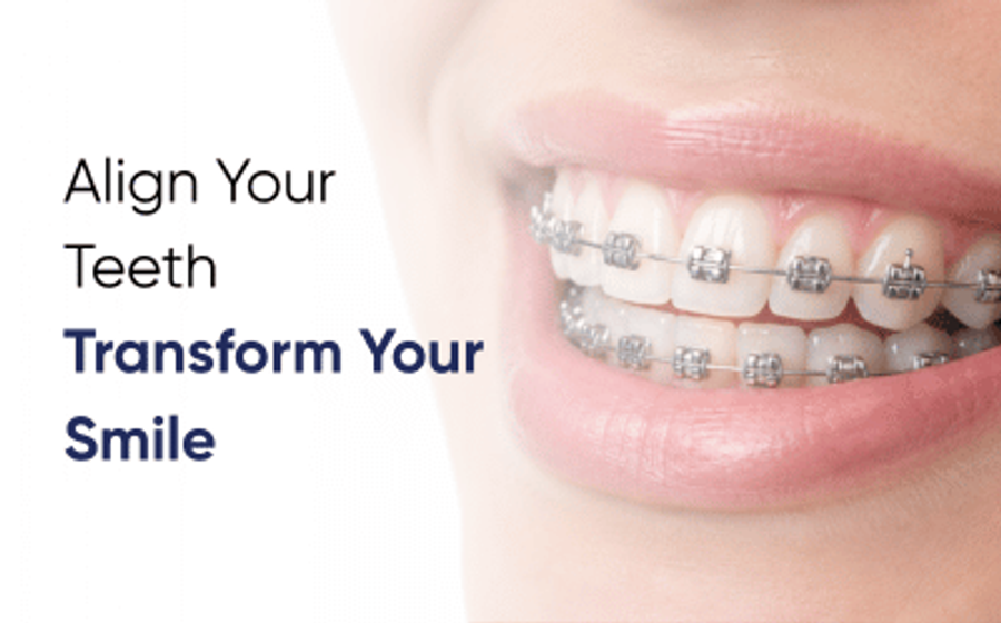 Close-up of metal teeth braces in Faisalabad at DentoCorrect People's Colony