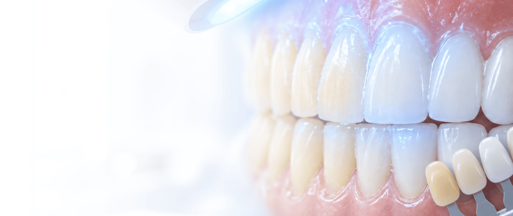 Professional teeth whitening in Rawalpindi with a shade guide at DentoCorrect Bahria Town