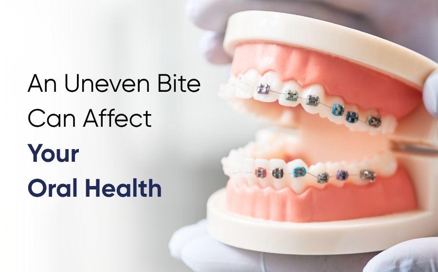 Model showing teeth braces for adult orthodontic treatment in Multan