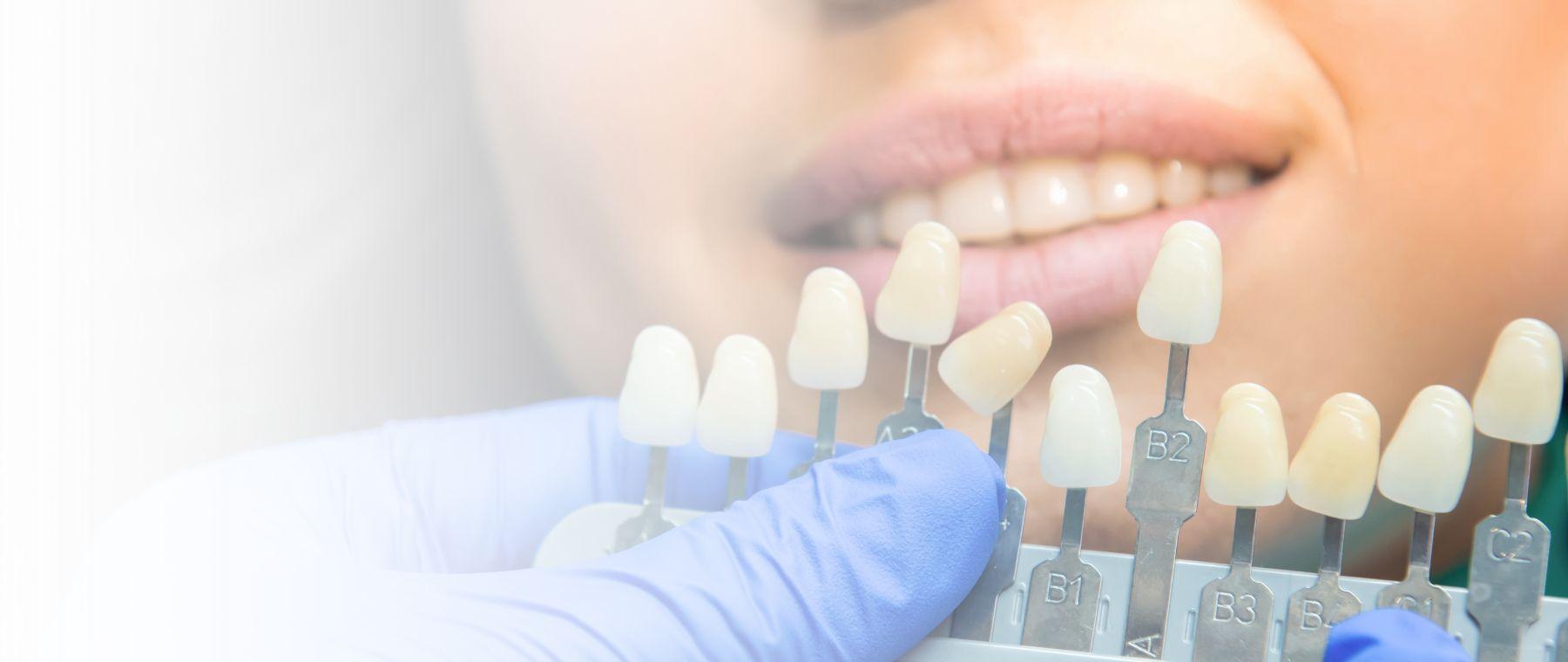 Shade guide being matched for dental veneers in Peshawar