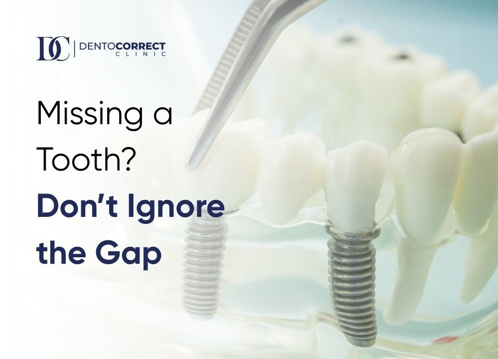 Dental implant posts in a jaw model, dental implants in Islamabad