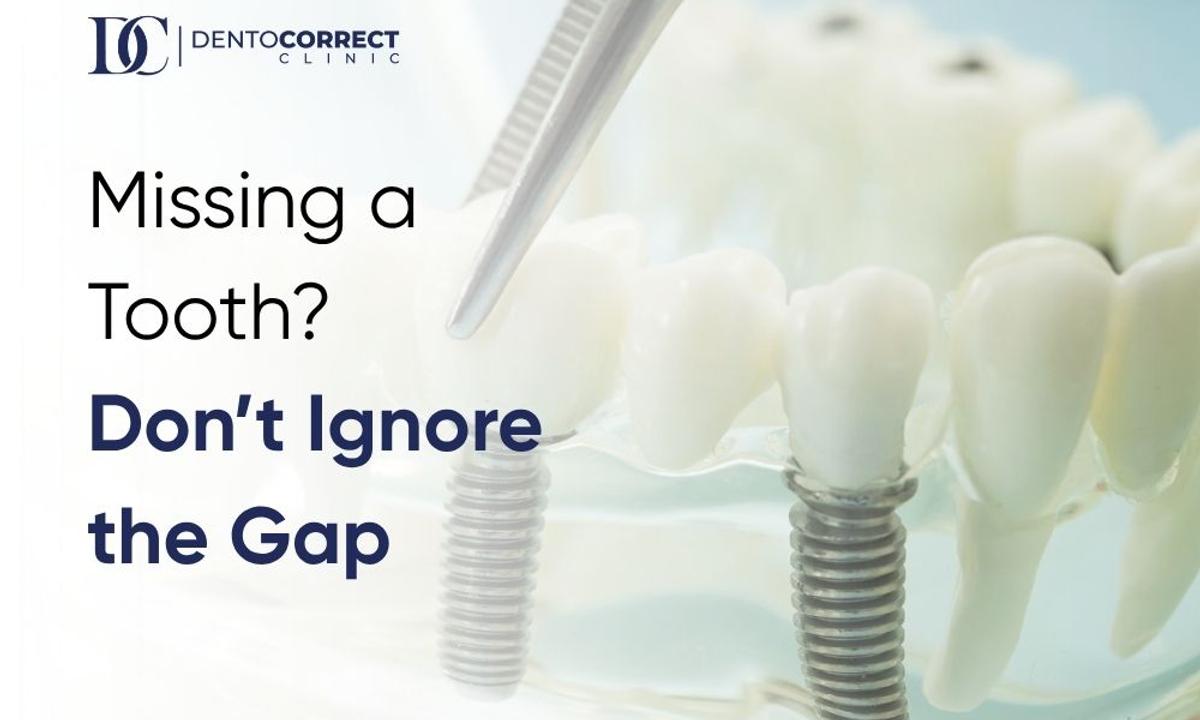 Dental implant posts in a jaw model, dental implants in Islamabad