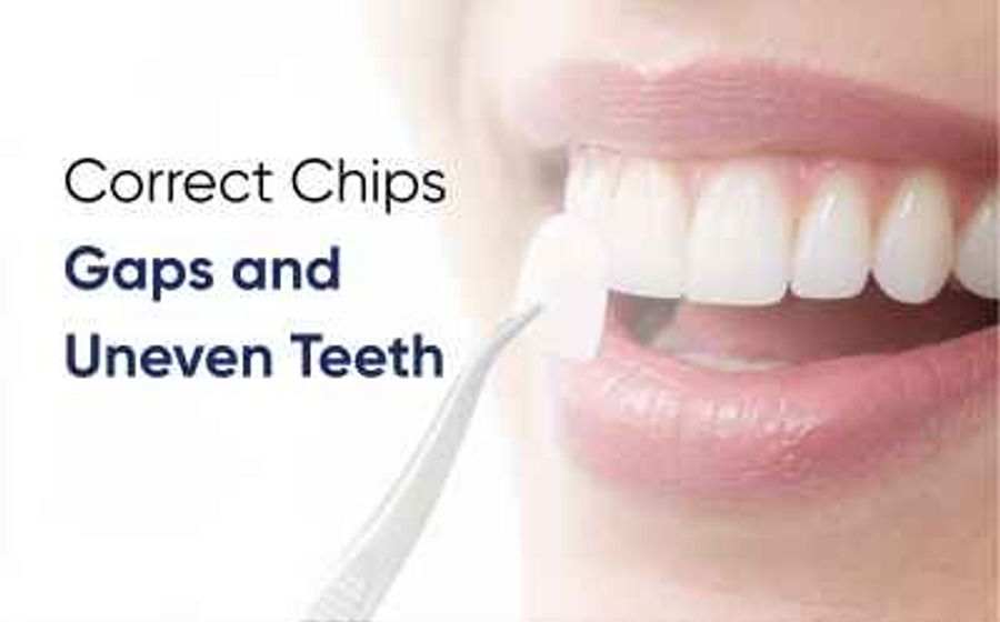 Dentist placing a porcelain veneer for dental veneers in Multan at DentoCorrect