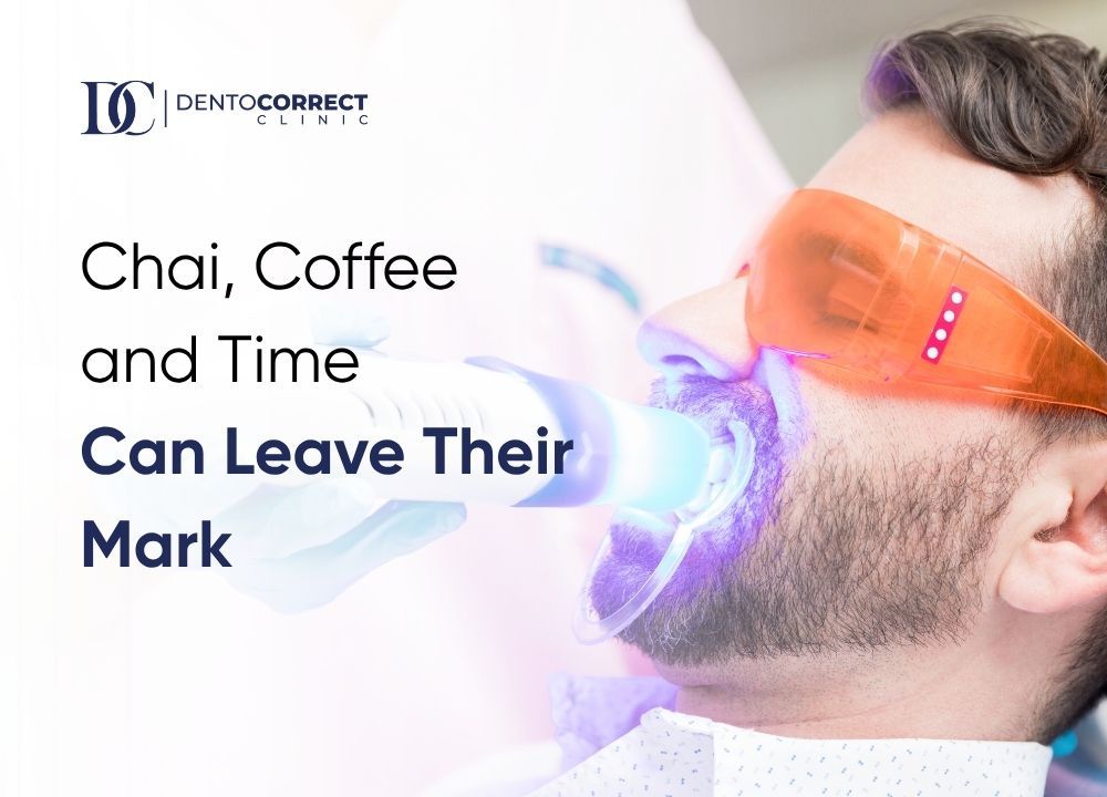 Teeth whitening in Faisalabad for patchy, uneven tooth color