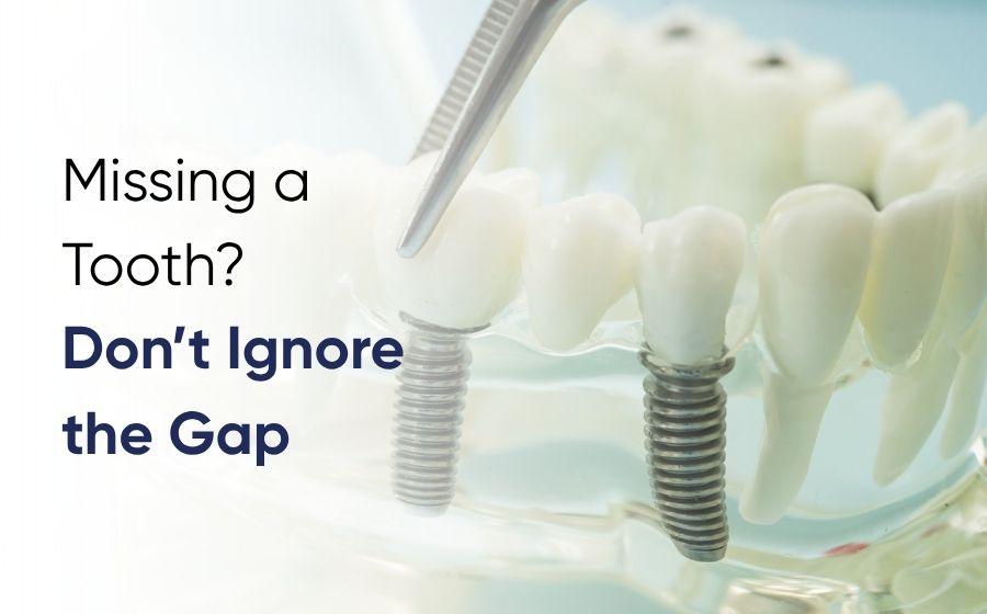 Dental implants in Islamabad shown on a jaw model at DentoCorrect