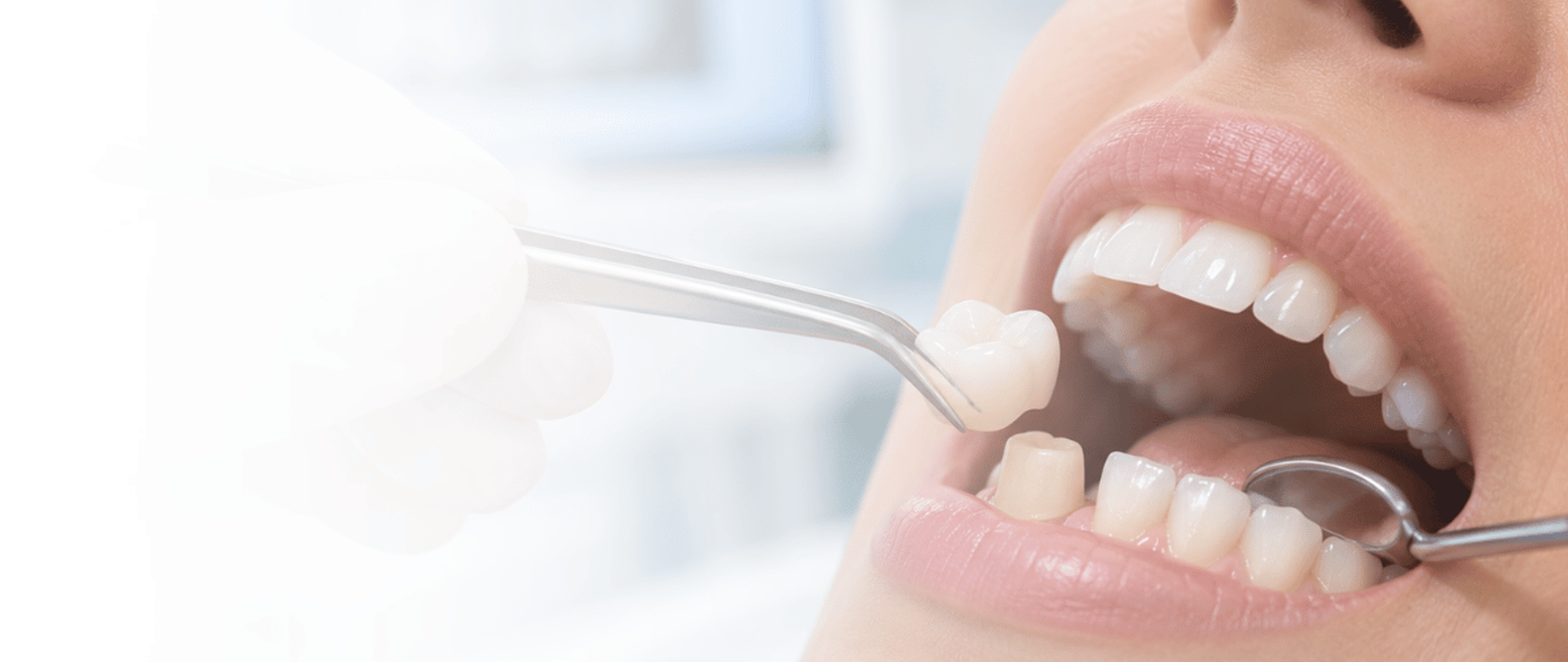 Dentist placing a dental crown on a discolored tooth in Multan at DentoCorrect