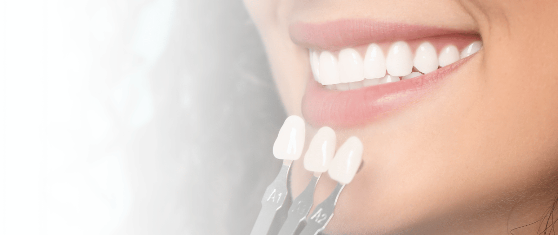 Dental veneers in Karachi matched against a patient smile using a shade guide