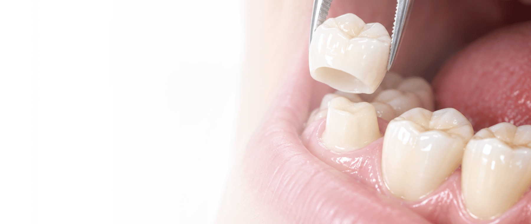 Dentist placing a ceramic crown during dental crowns in Lahore treatment at DentoCorrect
