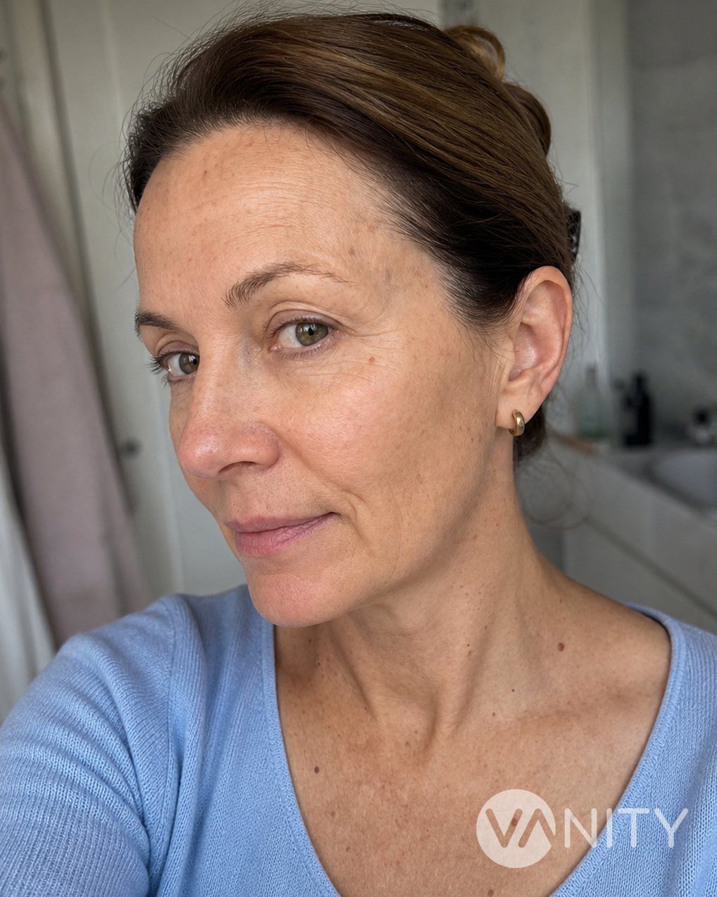 After Collagen biostimulators — illustrative, not a real patient