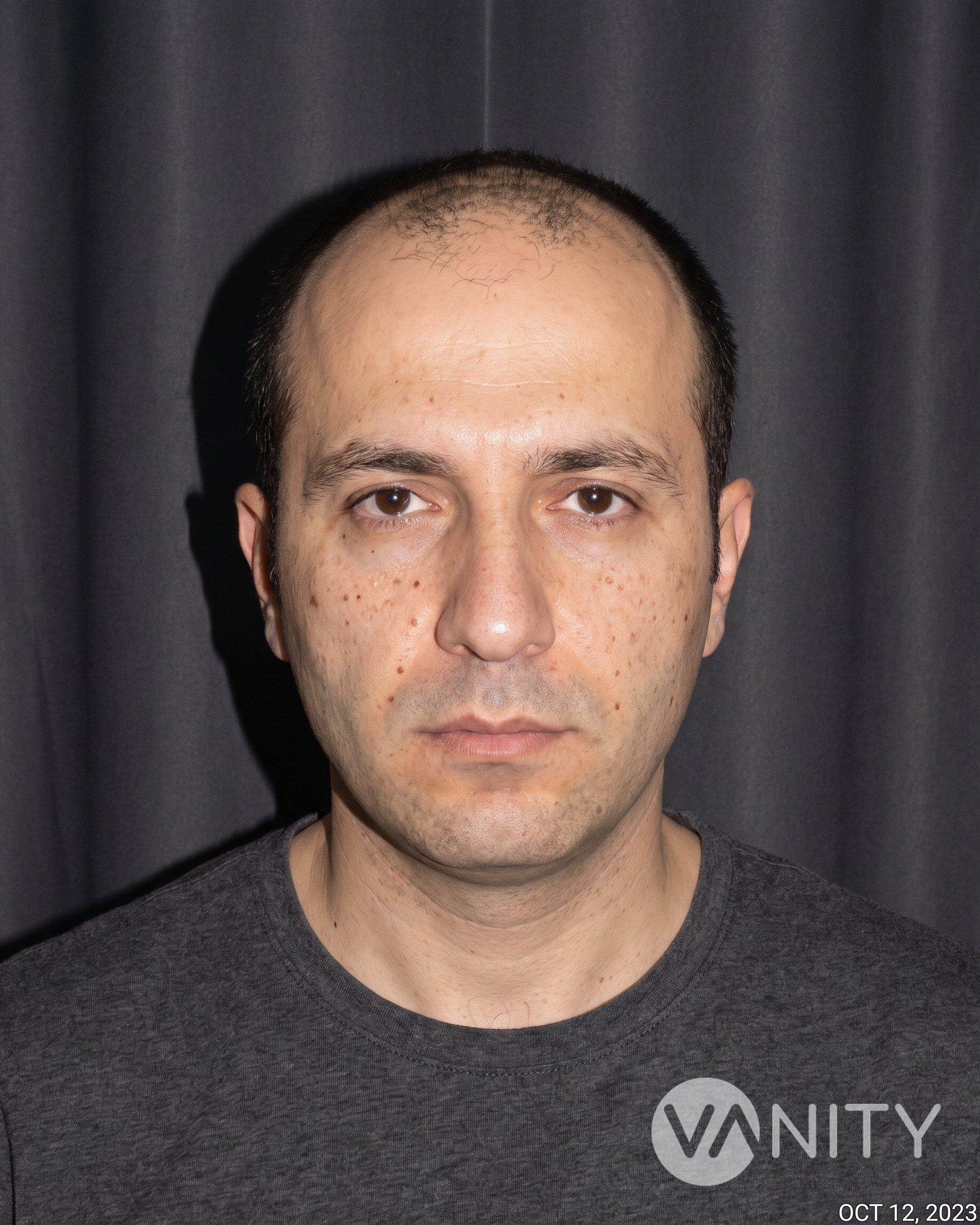 Before Hair transplant — illustrative, not a real patient